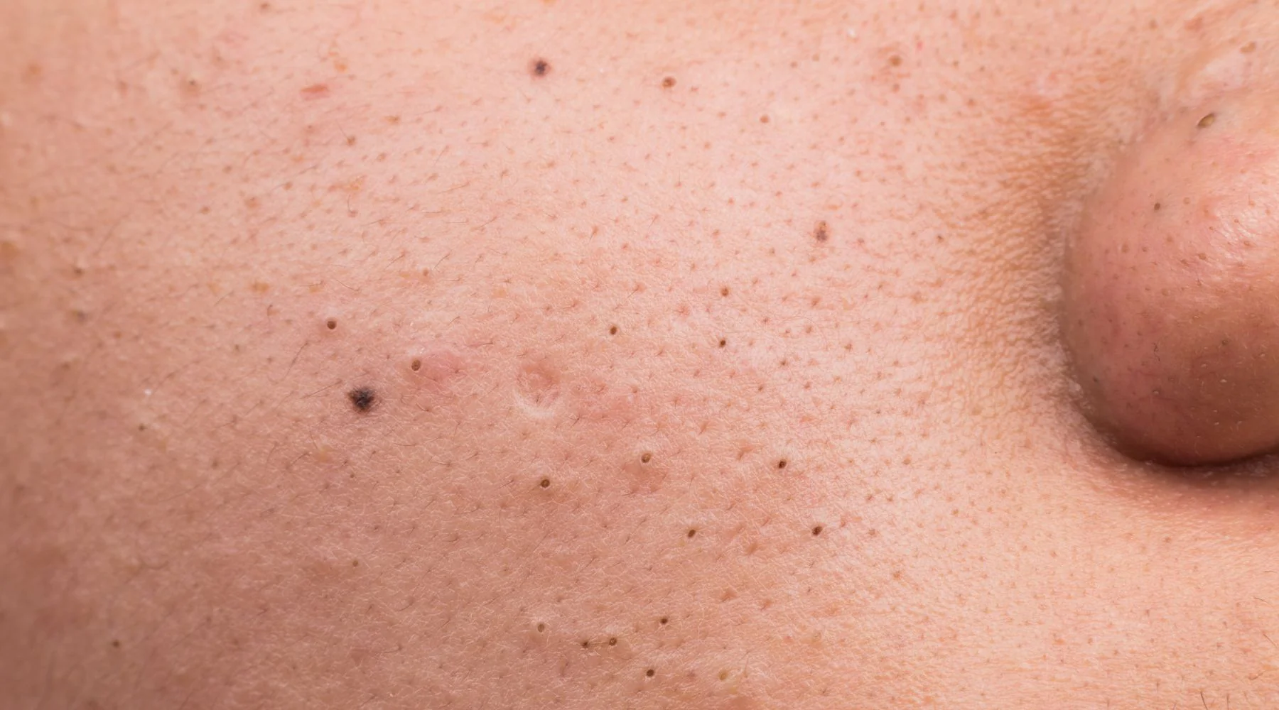 Cravos no Rosto: Causas, Tratamentos e Prevenção
